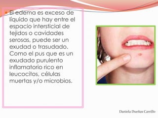  El edema es exceso de
 líquido que hay entre el
 espacio intersticial de
 tejidos o cavidades
 serosas, puede ser un
 exudad o trasudado.
 Como el pus que es un
 exudado purulento
 inflamatorio rico en
 leucocitos, células
 muertas y/o microbios.




                            Daniela Dueñas Carrillo
 