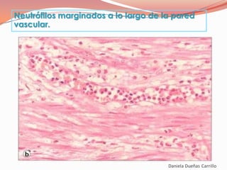 Neutrófilos marginados a lo largo de la pared
vascular.
 