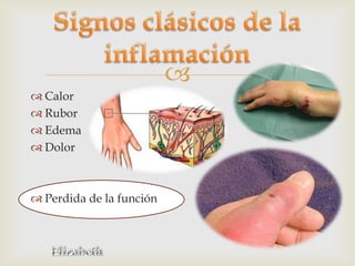 
 Calor
 Rubor
 Edema
 Dolor



 Perdida de la función
 