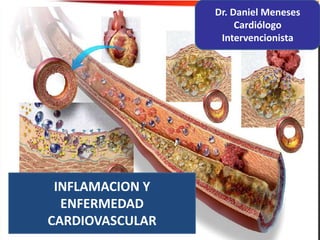 INFLAMACION Y
ENFERMEDAD
CARDIOVASCULAR
Dr. Daniel Meneses
Cardiólogo
Intervencionista
 