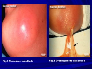 Fig.1 Abscesso - mandíbula   Fig.2 Drenagem do abscesso
 