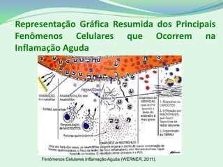 Representação Gráfica Resumida dos Principais
Fenômenos Celulares que Ocorrem na
Inflamação Aguda
Fenômenos Celulares Inflamação Aguda (WERNER, 2011).
 