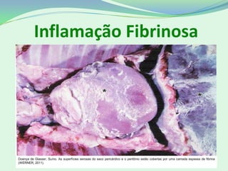 Inflamação Fibrinosa
Doença de Glasser, Suíno. As superfícies serosas do saco pericárdico e o peritônio estão cobertas por uma camada espessa de fibrina
(WERNER, 2011).
 