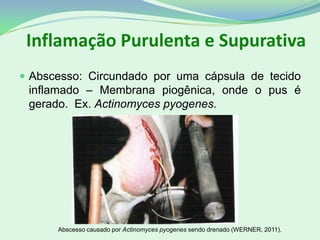 Inflamação Purulenta e Supurativa
 Abscesso: Circundado por uma cápsula de tecido
inflamado – Membrana piogênica, onde o pus é
gerado. Ex. Actinomyces pyogenes.
Abscesso causado por Actinomyces pyogenes sendo drenado (WERNER, 2011).
 