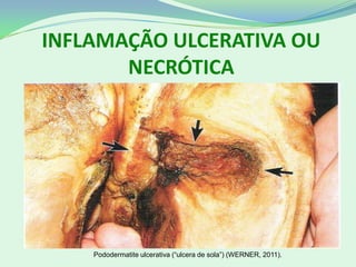 INFLAMAÇÃO ULCERATIVA OU
NECRÓTICA
Pododermatite ulcerativa (“ulcera de sola”) (WERNER, 2011).
 