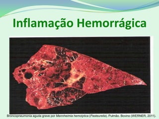 Broncopneumonia aguda grave por Mannheimia hemolytica (Pasteurella). Pulmão. Bovino (WERNER, 2011).
Inflamação Hemorrágica
 
