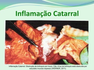 Inflamação Catarral
Inflamação Catarral. Obstrução de brônquio por muco. Cão. A luz do brônquio está obstruída por
exsudato mucoso espesso (WERNER, 2011).
 