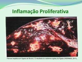 Inflamação Proliferativa
Fibrose hepática em fígado de Bovino. O resultado é a extrema rigidez do fígado (WERNER, 2011).
 
