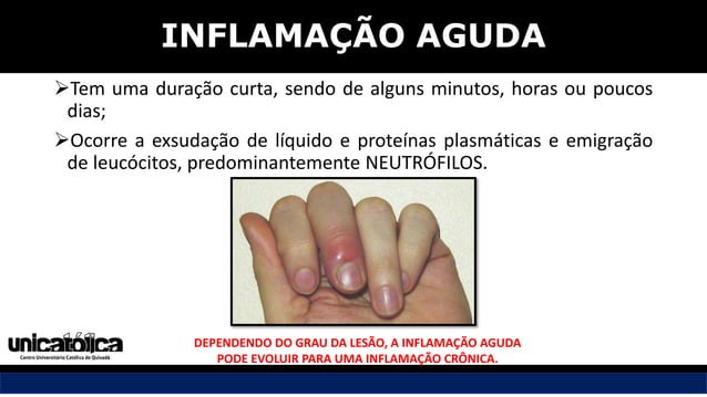 Inflamação aguda e crônica, InflamaçÃO Aguda E CRÔNICA