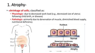 1. Atrophy-
• -shrinkage of cells; classified as:
• Physiologic--due to decreased work load (e.g., decreased size of uterus
following child birth, or disease)
• Pathologic--primarily due to denervation of muscle, diminished blood supply,
nutritional deficiency
 