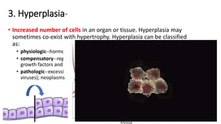 3. Hyperplasia-
• Increased number of cells in an organ or tissue. Hyperplasia may
sometimes co-exist with hypertrophy. Hyperplasia can be classified
as:
• physiologic--hormonal (e.g., breast and uterus during pregnancy)
• compensatory--regeneration of liver following partial hepatectomy. Various
growth factors and interluekins are important in such hyperplasia.
• pathologic--excessive hormonal stimulation, viral infection (papilloma
viruses); neoplasms
 