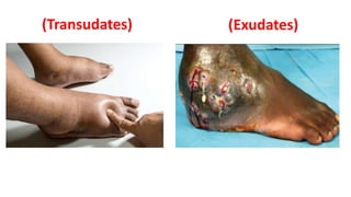 (Transudates) (Exudates)
 