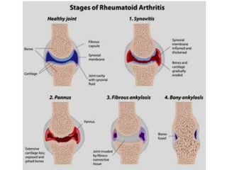 Inflamatory arthritis | PPTX