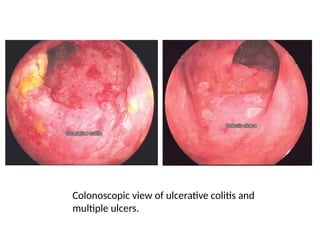 Inflamatory bowel disease.1332446677pptx | PPTX
