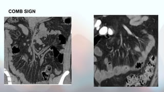 INFLAMATORY BOWL DISEASE orals.pptx