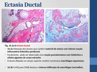 Fig. 16.3a-b Ectasia ductal
• 16.3a Dilatação dos ductos que contêm material de estase com intensa reação
inflamatória linfocítica periductal.
• Focalmente, pode ser observado uma reação granulomatosa com histiócitos e
células gigantes de corpo estranho
• O ducto dilatado no campo superior contém numerosos macrófagos espumosos.
• 16.3b A IHQ para CD68 destaca a intensa infiltração de macrófagos (vermelho).
Ectasia Ductal
 