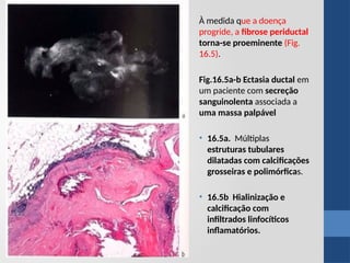 À medida que a doença
progride, a fibrose periductal
torna-se proeminente (Fig.
16.5).
Fig.16.5a-b Ectasia ductal em
um paciente com secreção
sanguinolenta associada a
uma massa palpável
• 16.5a. Múltiplas
estruturas tubulares
dilatadas com calcificações
grosseiras e polimórficas.
• 16.5b Hialinização e
calcificação com
infiltrados linfocíticos
inflamatórios.
 