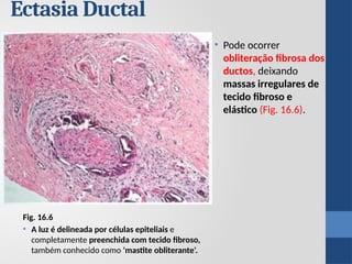 Fig. 16.6
• A luz é delineada por células epiteliais e
completamente preenchida com tecido fibroso,
também conhecido como 'mastite obliterante'.
Ectasia Ductal
• Pode ocorrer
obliteração fibrosa dos
ductos, deixando
massas irregulares de
tecido fibroso e
elástico (Fig. 16.6).
 