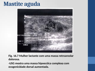 Fig. 16.7 Mulher lactante com uma massa retroareolar
dolorosa.
-USG mostra uma massa hipoecóica complexa com
ecogenicidade dorsal aumentada.
Mastite aguda
 