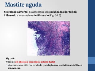 Microscopicamente, os abscessos são circundados por tecido
inflamado e eventualmente fibrosado (Fig. 16.8).
Mastite aguda
Fig. 16.8
Visão de um abscesso associado a ectasia ductal.
• abscesso é revestido por tecido de granulação com leucócitos neutrófilos e
macrófagos.
 