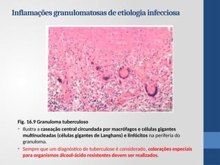 Fig. 16.9 Granuloma tuberculoso
• Ilustra a caseação central circundada por macrófagos e células gigantes
multinucleadas (células gigantes de Langhans) e linfócitos na periferia do
granuloma.
• Sempre que um diagnóstico de tuberculose é considerado, colorações especiais
para organismos álcool-ácido resistentes devem ser realizados.
Inflamaçõesgranulomatosasdeetiologiainfecciosa
 