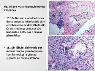 Fig. 16.10a Mastite granulomatosa
idiopática.
• 16.10a Natureza lobulocêntrica
desse processo inflamatório com
envolvimento de dois lóbulos (L).
Os constituintes celulares são
histiócitos, linfócitos e células
plasmáticas.
• 16.10b lóbulo obliterado por
intensa reação granulomatosa
com histiócitos e células
gigantes de corpo estranho.
 