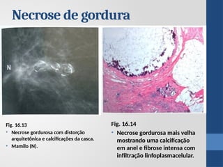 Fig. 16.13
• Necrose gordurosa com distorção
arquitetônica e calcificações da casca.
• Mamilo (N).
Necrose de gordura
Fig. 16.14
• Necrose gordurosa mais velha
mostrando uma calcificação
em anel e fibrose intensa com
infiltração linfoplasmacelular.
 