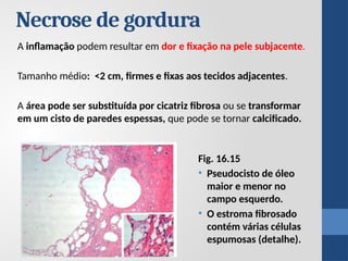 Necrose de gordura
A inflamação podem resultar em dor e fixação na pele subjacente.
Tamanho médio: <2 cm, firmes e fixas aos tecidos adjacentes.
A área pode ser substituída por cicatriz fibrosa ou se transformar
em um cisto de paredes espessas, que pode se tornar calcificado.
Fig. 16.15
• Pseudocisto de óleo
maior e menor no
campo esquerdo.
• O estroma fibrosado
contém várias células
espumosas (detalhe).
 