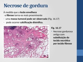 Fig. 16.17
• Necrose gordurosa
antiga com
substituição do
tecido necrótico
por tecido fibroso
À medida que a lesão envelhece
-a fibrose torna-se mais proeminente
- uma massa tumoral pode ser observada (Fig. 16.17)
- pode ocorrer calcificação distrófica.
Necrose de gordura
 
