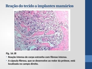 Reação do tecido a implantes mamários
Fig. 16.18
• Reação intensa de corpo estranho com fibrose intensa.
• A cápsula fibrosa, que se desenvolve ao redor da prótese, está
localizada no campo direito.
 