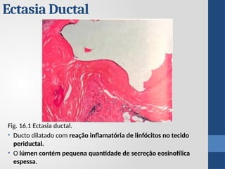 Ectasia Ductal
Fig. 16.1 Ectasia ductal.
• Ducto dilatado com reação inflamatória de linfócitos no tecido
periductal.
• O lúmen contém pequena quantidade de secreção eosinofílica
espessa.
 
