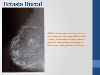 Ectasia Ductal
-Clinicamente, o paciente apresentava
corrimento amarelo espontâneo e leve
endurecimento do tecido periareolar.
-MMG: Calcificações semelhantes a
bastonetes ao longo de um único ducto.
 