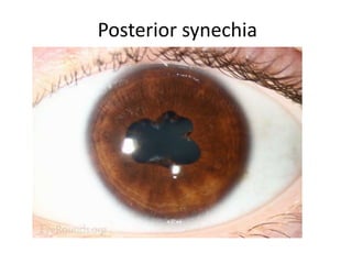 Posterior synechia
 