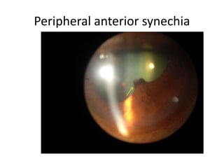 Peripheral anterior synechia
 