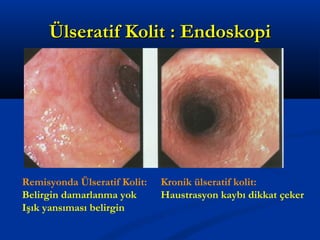 ÜÜllsseerraattiiff KKoolliitt :: EEnnddoosskkooppii 
Remisyonda Ülseratif Kolit: 
Belirgin damarlanma yok 
Işık yansıması belirgin 
Kronik ülseratif kolit: 
Haustrasyon kaybı dikkat çeker 
 