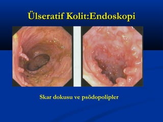 ÜÜllsseerraattiiff KKoolliitt::EEnnddoosskkooppii 
Skar dokusu ve psödopolipler 
 