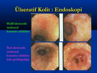 ÜÜllsseerraattiiff KKoolliitt :: EEnnddoosskkooppii 
Hafif derecede 
mukozal 
kanama odakları 
İleri derecede 
mukozal 
kanama odakları 
(ok: psödopolip) 
 