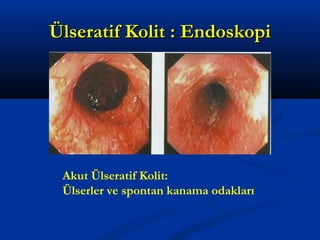 ÜÜllsseerraattiiff KKoolliitt :: EEnnddoosskkooppii 
Akut Ülseratif Kolit: 
Ülserler ve spontan kanama odakları 
 