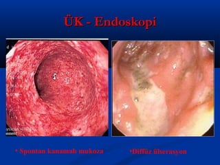 ÜÜKK -- EEnnddoosskkooppii 
• Spontan kanamalı mukoza •Diffüz ülserasyon 
 