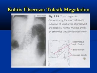 KKoolliittiiss ÜÜllsseerroozzaa:: TTookkssiikk MMeeggaakkoolloonn 
 