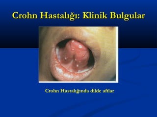 CCrroohhnn HHaassttaallıığğıı:: KKlliinniikk BBuullgguullaarr 
Crohn Hastalığında dilde aftlar 
 