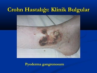 CCrroohhnn HHaassttaallıığğıı:: KKlliinniikk BBuullgguullaarr 
Pyoderma gangrenosum 
 