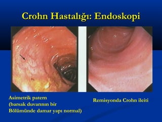 CCrroohhnn HHaassttaallıığğıı:: EEnnddoosskkooppii 
Asimetrik patern 
(barsak duvarının bir 
Bölümünde damar yapı normal) 
Remisyonda Crohn ileiti 
 