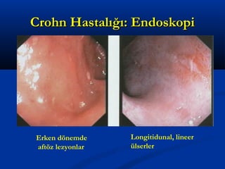 CCrroohhnn HHaassttaallıığğıı:: EEnnddoosskkooppii 
Erken dönemde 
aftöz lezyonlar 
Longitidunal, lineer 
ülserler 
 