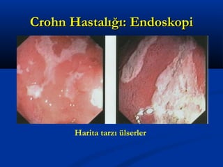 CCrroohhnn HHaassttaallıığğıı:: EEnnddoosskkooppii 
Harita tarzı ülserler 
 