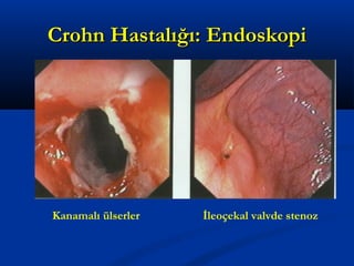 CCrroohhnn HHaassttaallıığğıı:: EEnnddoosskkooppii 
Kanamalı ülserler İleoçekal valvde stenoz 
 