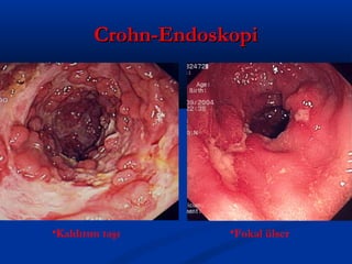 CCrroohhnn--EEnnddoosskkooppii 
•Kaldırım taşı •Fokal ülser 
 