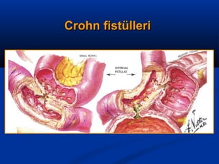 CCrroohhnn ffiissttüülllleerrii 
 