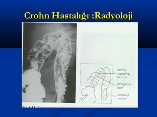 CCrroohhnn HHaassttaallıığğıı ::RRaaddyyoolloojjii 
 