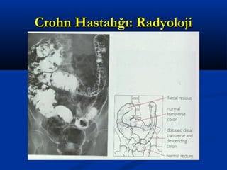 CCrroohhnn HHaassttaallıığğıı:: RRaaddyyoolloojjii 
 